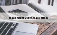 腋臭手术图片全过程,腋臭手术图解